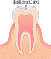 C0（初期の虫歯）