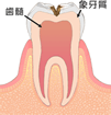 C2（象牙質が虫歯に）