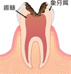 C3（神経に達した虫歯）